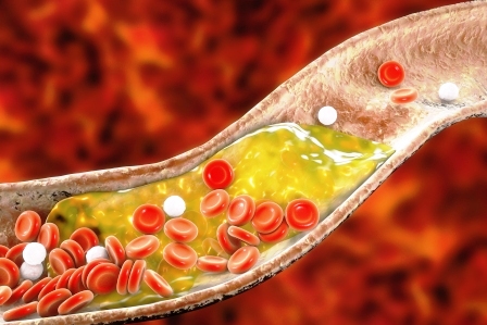 cholesterol v tepne znizuje pohankovy caj