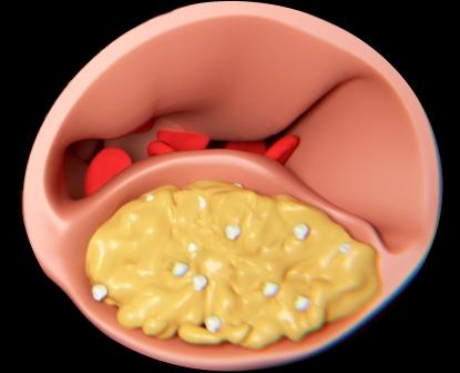 znizenie cholesterolu